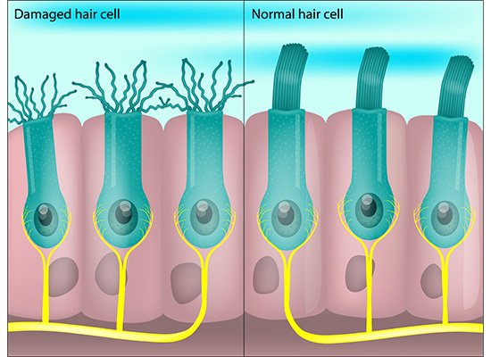 Sensorineural hearing loss