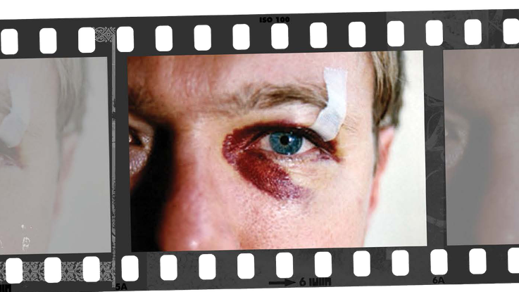 Eye injury