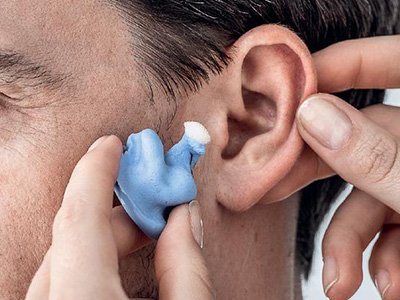 Abdrucknahme für eine Otoplastik